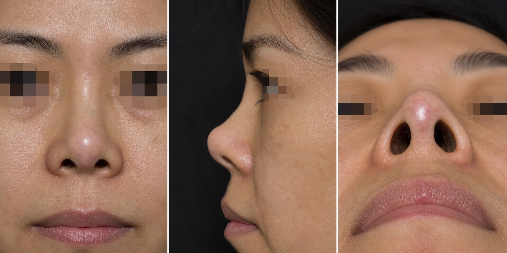 ภาพจำลอง แสดงผิวปลายจมูกบางจากแรงกดของวัสดุ