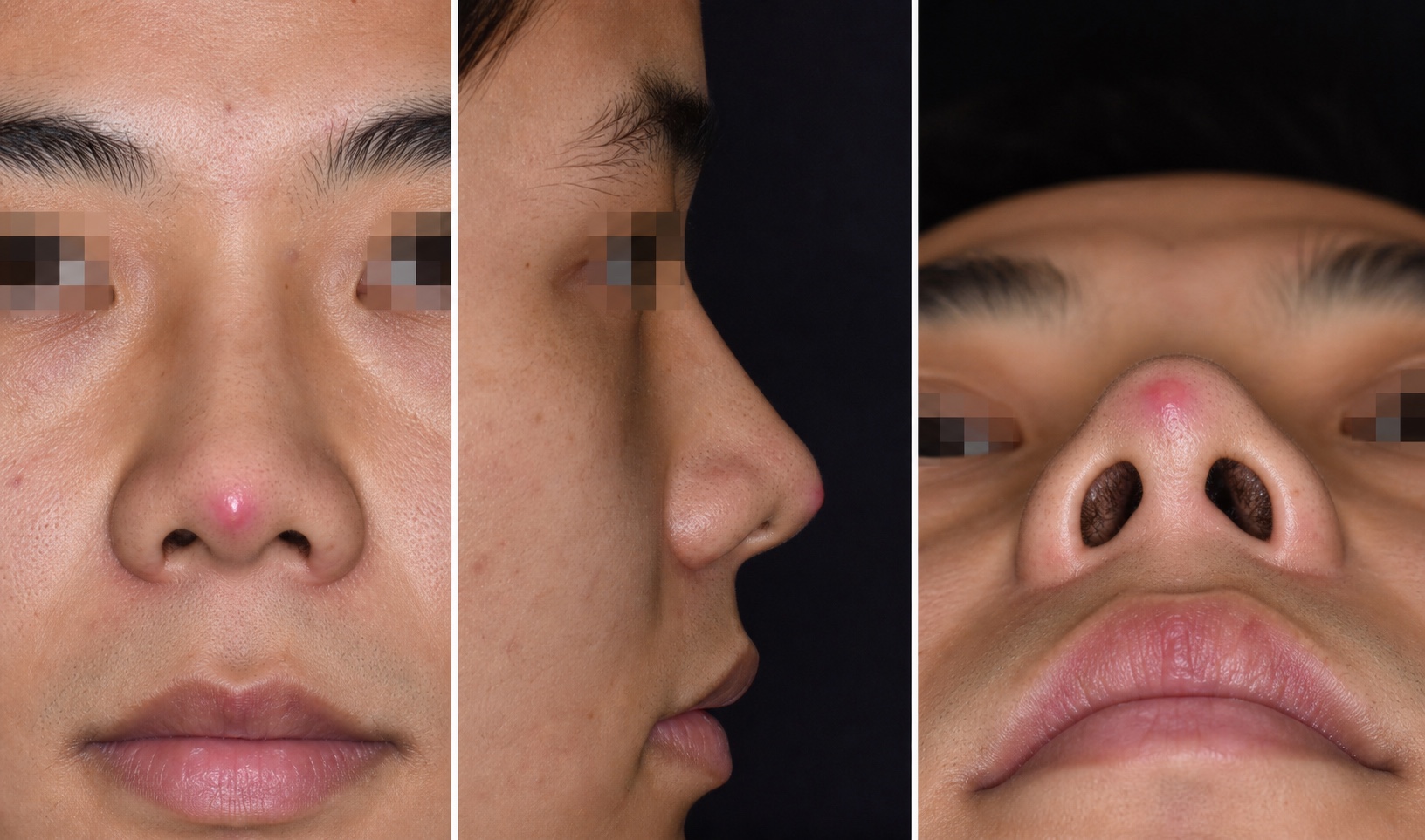 ภาพจำลอง แสดงสัญญาณวัสดุใกล้โผล่ผ่านผิวปลายจมูก